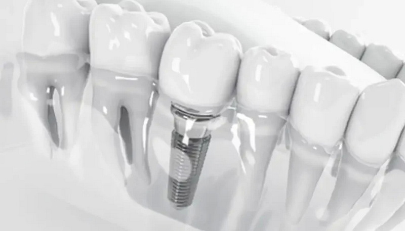 are copd patients canidate for dental implant or not