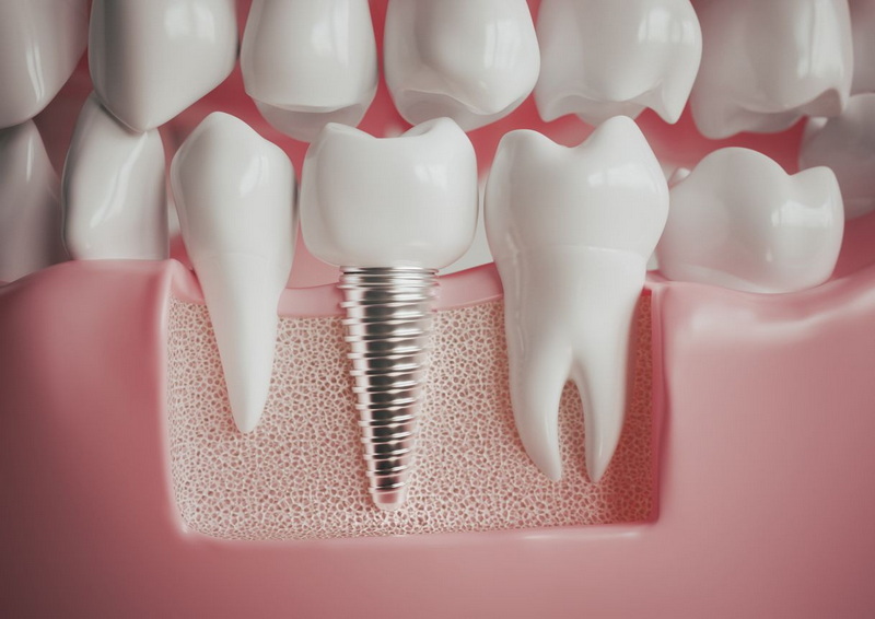 will my dental implant set off metal detector