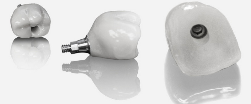 What Are The Advantages of Using An Osstem Healing Abutment?