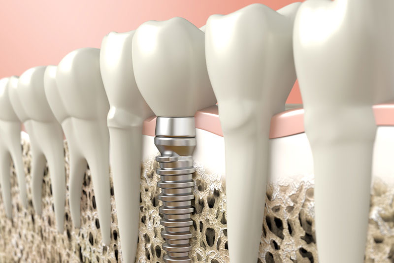 imz fertigungs dental abutment