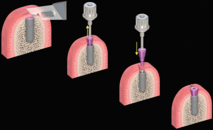 index dental abutment implants