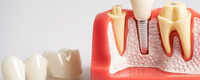 //iirorwxhloqjli5p.ldycdn.com/cloud/lpBpkKloljSRrlmlklqqjq/dental-healing-abutment-fell-out.jpg