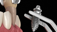 //iirorwxhloqjli5p.ldycdn.com/cloud/lpBpkKloljSRrlmlnjnmjq/dental-abutment-and-crown-at-same-time.jpg