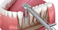 //iirorwxhloqjli5p.ldycdn.com/cloud/lpBpkKloljSRrlmlojijjo/dental-abutment-bases.jpg