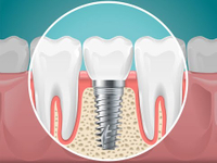 //iirorwxhloqjli5p.ldycdn.com/cloud/lpBpkKloljSRrlnlnjlljo/can-you-get-dental-implant-in-other-countries.jpg