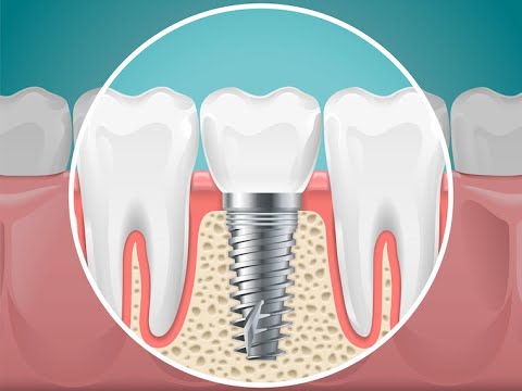 can you get dental implant in other countries