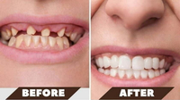 //iirorwxhloqjli5p.ldycdn.com/cloud/lpBpkKloljSRrlqlllomjq/can-you-have-a-dental-implant-removed.jpg