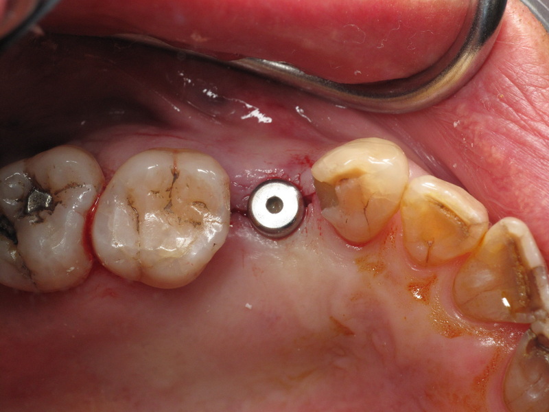 abutment screw fell out