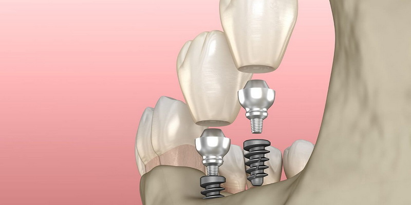 can you swim after dental implant surgery