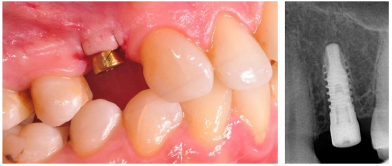 is dental implant covered under cghs