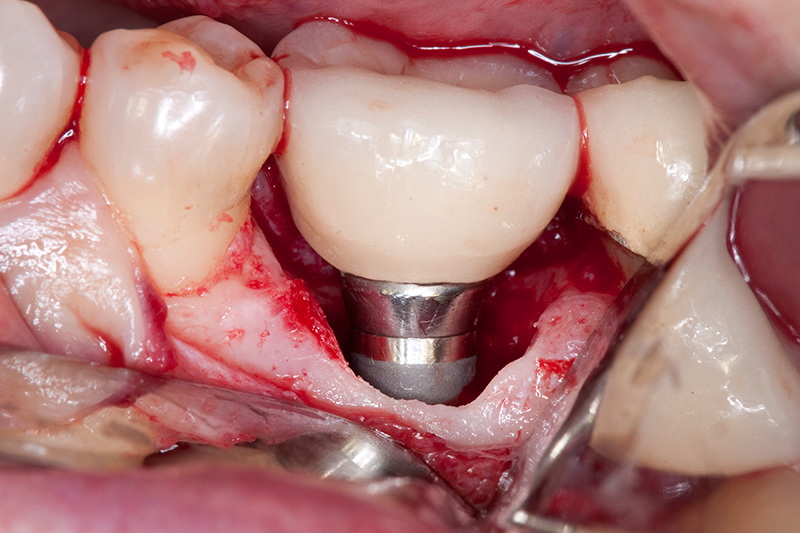 should i have one stage or two stage dental implant