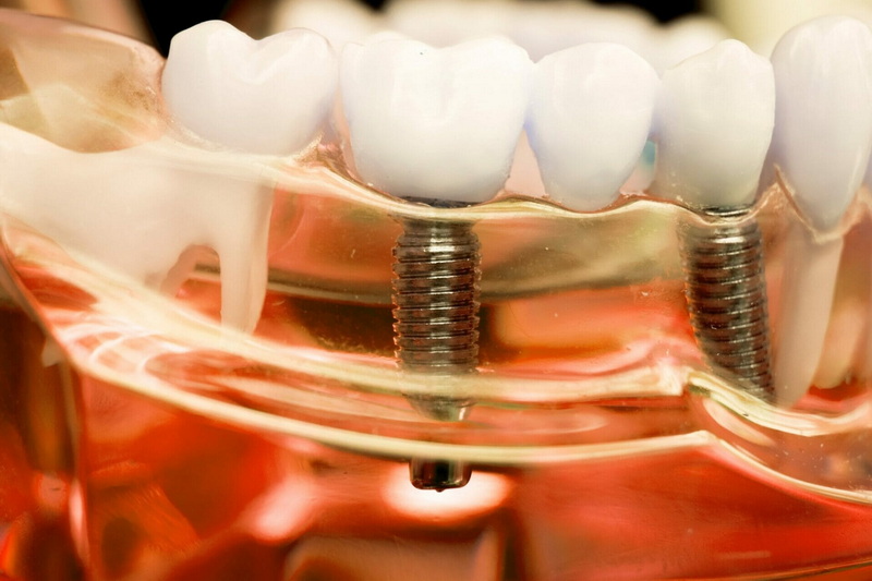 What Are The Different Types of Nobel Implant Healing Abutments?