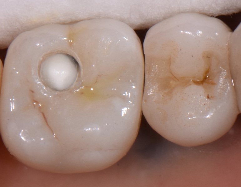 implant crown became loose due to broken abutment screw