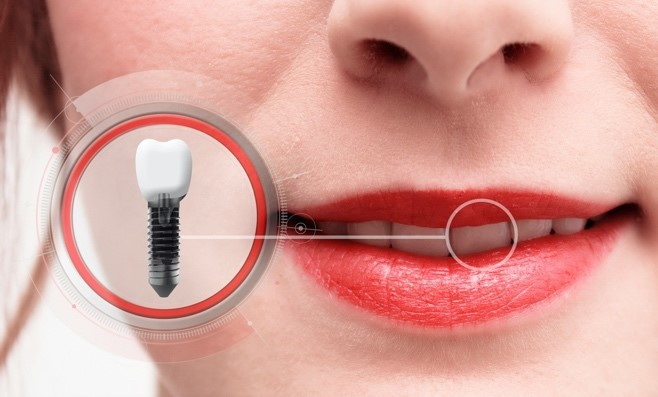 How To Know If Your Tooth Implant Healing Abutment Is Healing Properly?