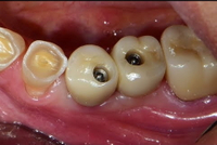 //iirorwxhloqjli5p.ldycdn.com/cloud/lqBpkKloljSRilliljlqjo/looose-abutment-screw.jpg