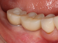 //iirorwxhloqjli5p.ldycdn.com/cloud/lqBpkKloljSRillilnjojo/3i-biomet-healing-abutment.jpg