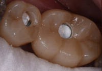 //iirorwxhloqjli5p.ldycdn.com/cloud/lqBpkKloljSRillinrmkjo/implant-abutment-screw-access-channel.jpg