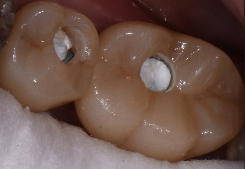 implant abutment screw access channel