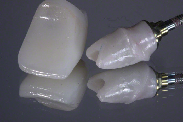 How Long Should An Astra TX Healing Abutment Stay In Place?