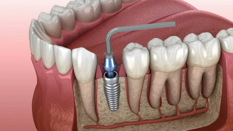What Tools Are Used For Torquing Omniloc 4.0 Abutment Screws?