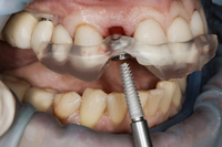 //iirorwxhloqjli5p.ldycdn.com/cloud/lqBpkKloljSRiloroplpjq/do-i-need-antibiotics-before-dental-implant.jpg