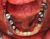 //iirorwxhloqjli5p.ldycdn.com/cloud/lqBpkKloljSRilprlnpqjq/gold-coated-implant-abutment-screw.jpg