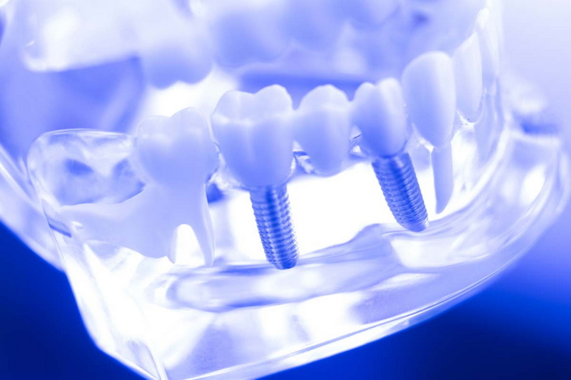 how painful is a dental implant_05