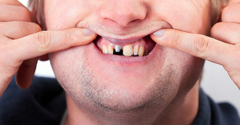 Can A Loose Dental Implant Be Saved?