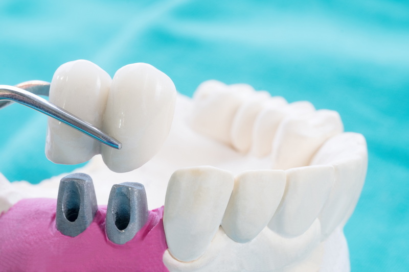 how do you clean dental implant dentures