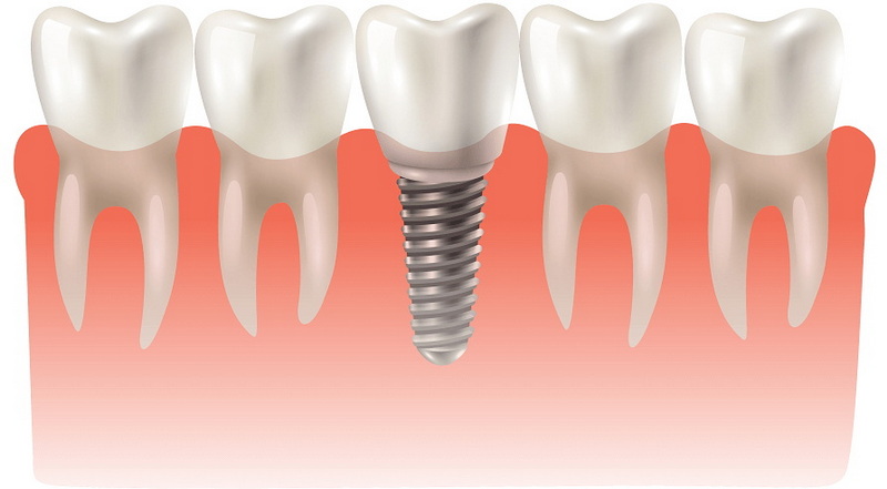 how soon can i fly after dental implant surgery