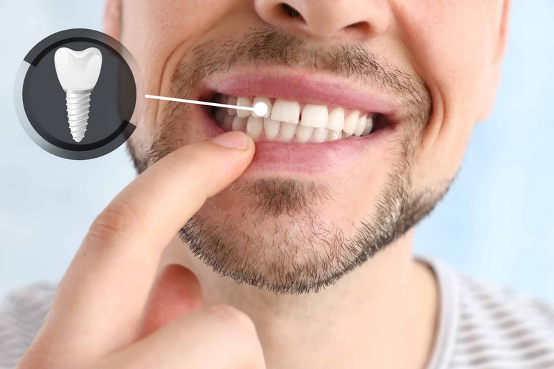 How Safe Is Dental Implant?