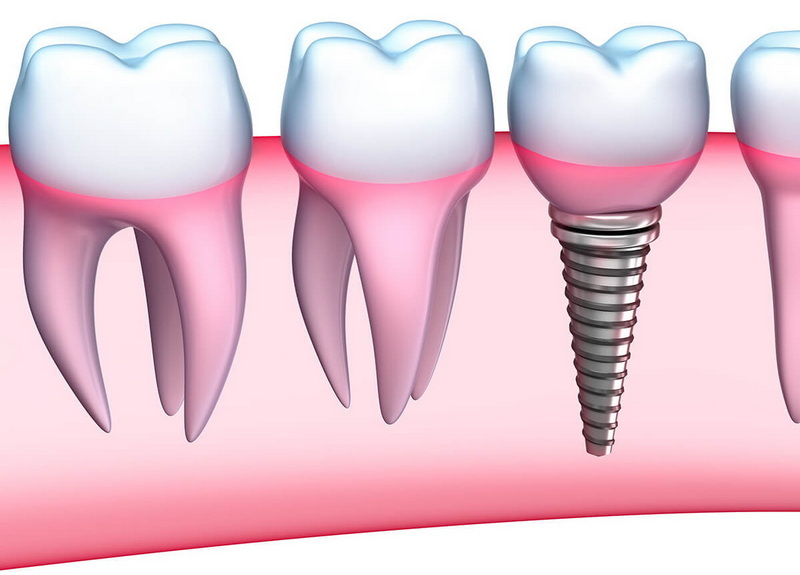 How To Prepare for A Dental Implant?