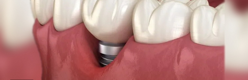 my dental implant sensitive to cold_1