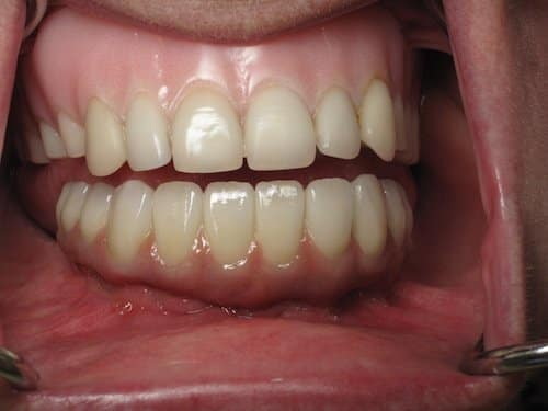 no dairy after dental implant reddit_1