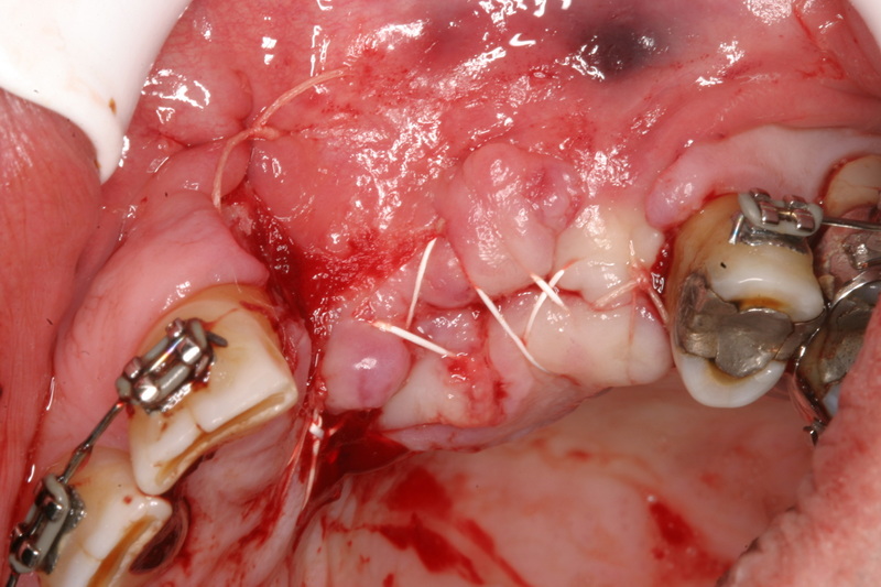 what happens if a dental implant fails_11