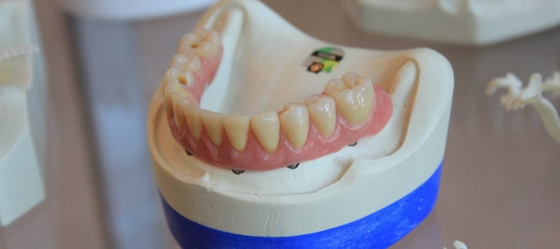When Can I Eat Solid Food After Dental Implant?