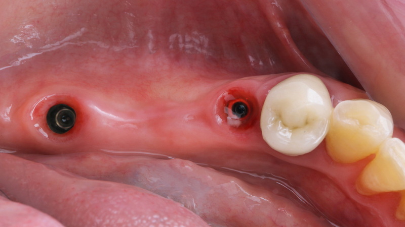 what material is dental implant commonly fabricated from_3
