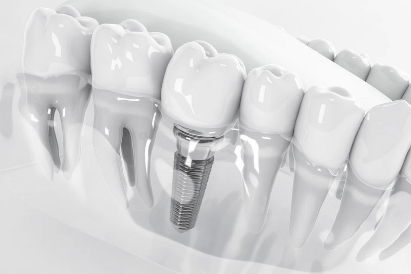Who Should Not Get A Dental Implant?