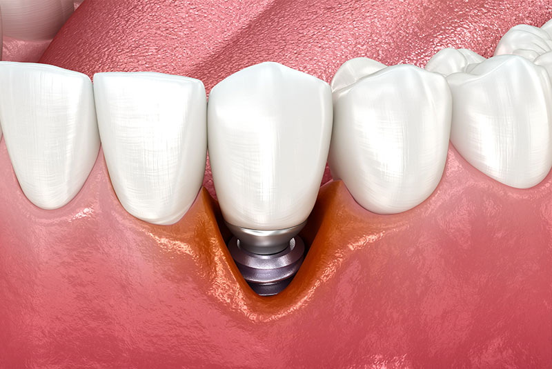 why does my dental implant feel weird_3