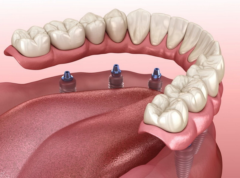 Why Do I Need A Dental Implant?