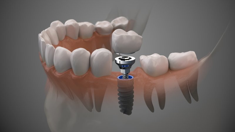 what is bone graft for a dental implant_1