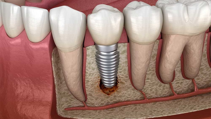 the average lifespan of a dental implant_3
