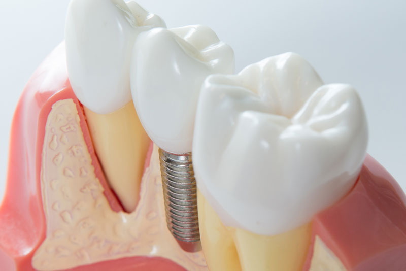 what is dental implant placement_3