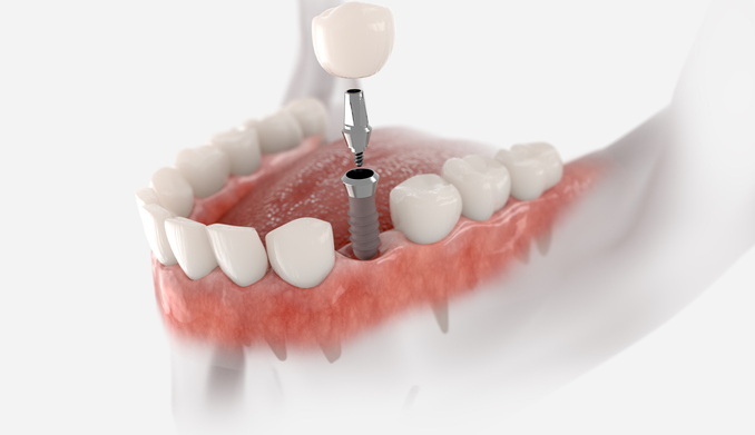 dental implant_3