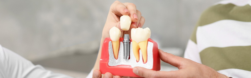 What Can Go Wrong with A Dental Implant?