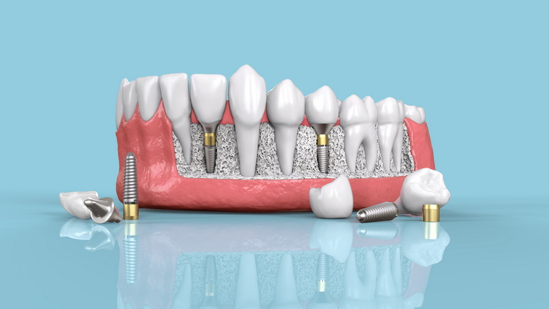 What Can I Get Instead of A Dental Implant?