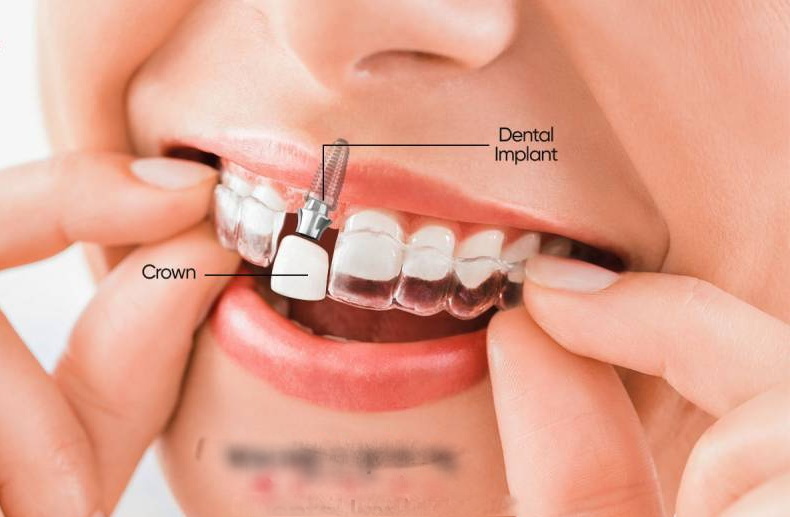 is dental implant orthodontics_3