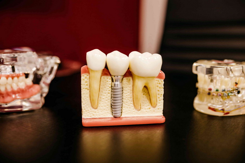 dental implant be exposed_3