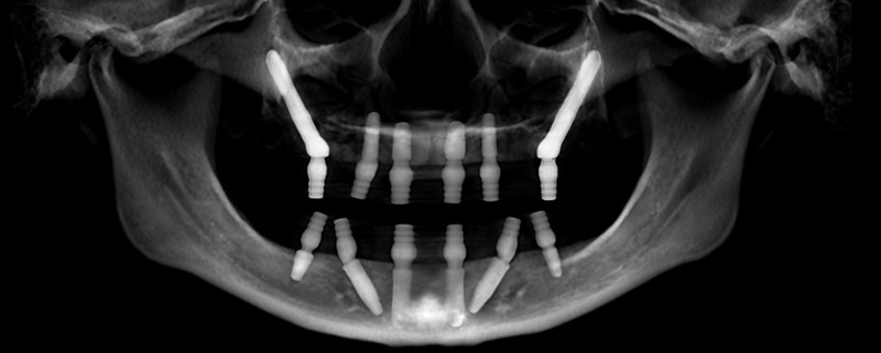 if your dental implant fails_1