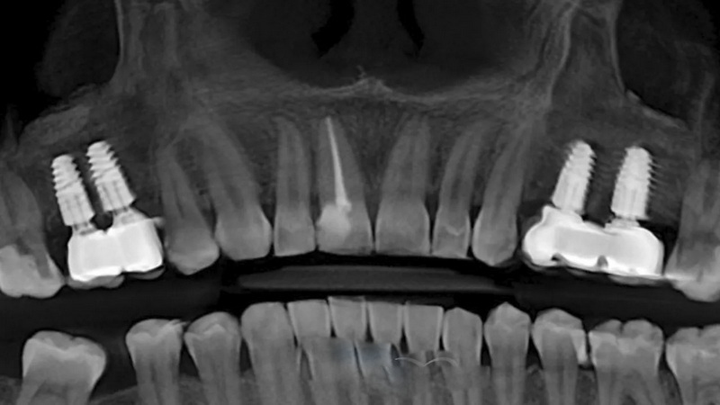 how many appointments for a dental implant_07